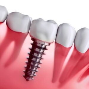 ایمپلنت در دندانسازی